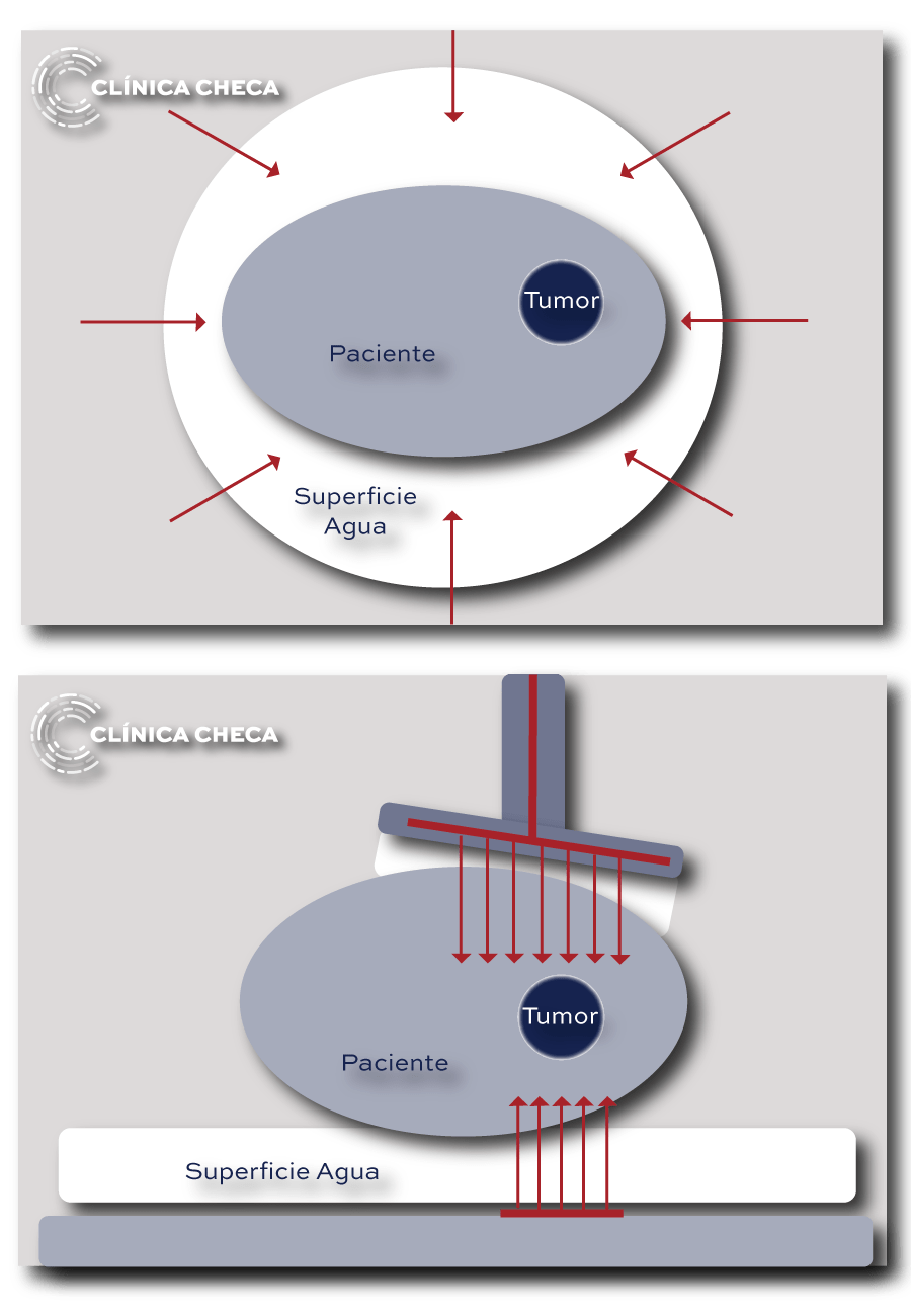 Oncothermia en tratamiento contra el cáncer