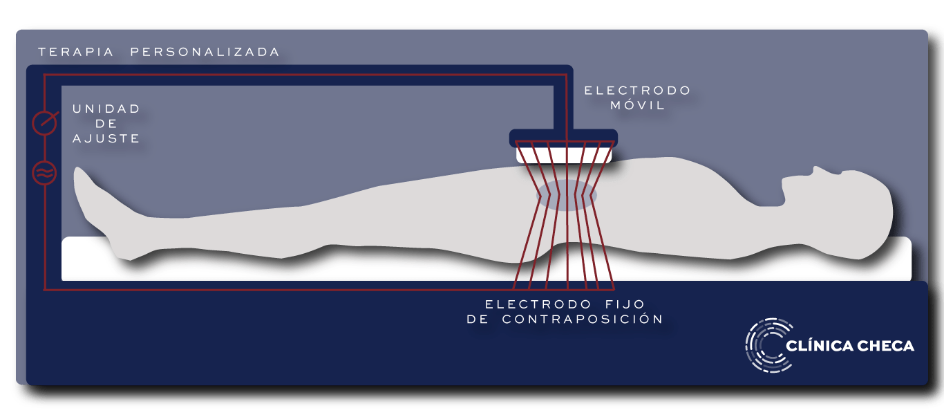 Tratamiento de Oncothermia en Clínica Checa